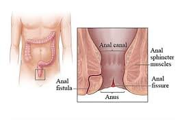 Cost Comparison: Anal Fistula Surgery vs. Hiatus Hernia Surgery in Dubai