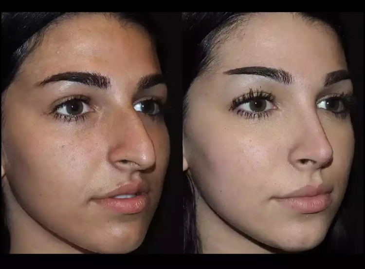 Rhinoplasty in Dubai: Essential Aftercare Tips for Best Results