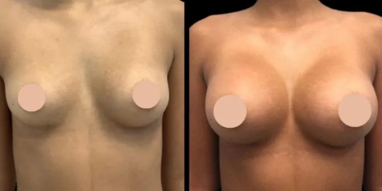 Why Choose the Best Breast Augmentation Surgeons in Dubai